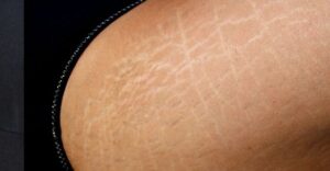Apa Itu Stretch Mark? Ini Penjelasanya