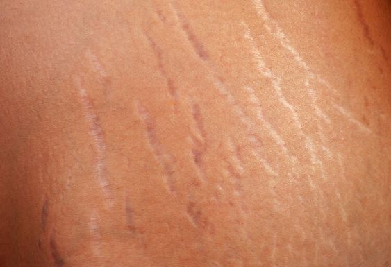 Apakah Stretch Mark Bisa Menyebar