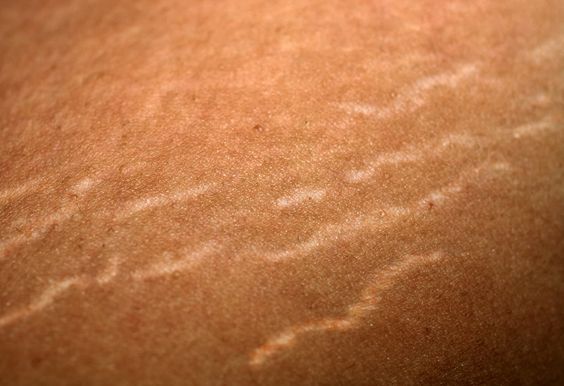 Cara Menghilangkan Stretch Mark