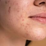 Ciri-Ciri Tidak Cocok dengan Skincare