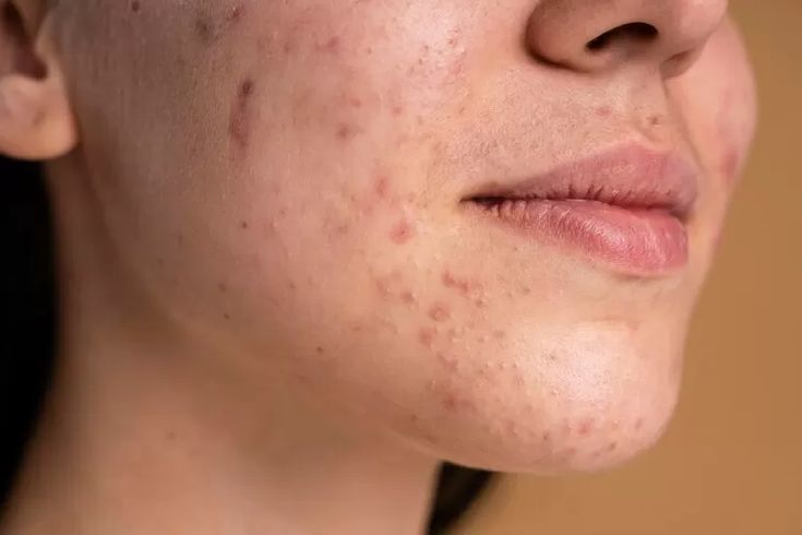 Ciri-Ciri Tidak Cocok dengan Skincare dan Cara Mengatasinya