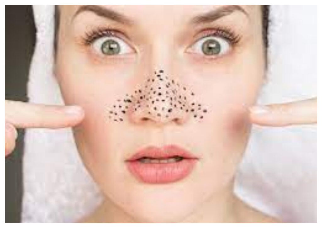 Tips Ampuh Atasi Komedo Hitam dengan Skincare dan Bahan Alami