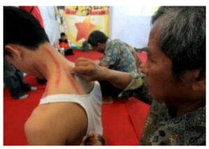 Pengobatan Alternatif Kerokan, Praktik Pengobatan Tradisional dengan Beragam Potensi Kesehatan