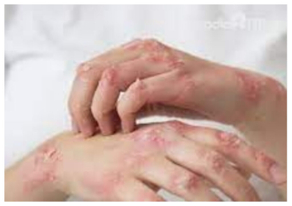 Seruan Afrika untuk Dunia: Stop Larangan Perjalanan, Fokus pada Vaksinasi Mpox