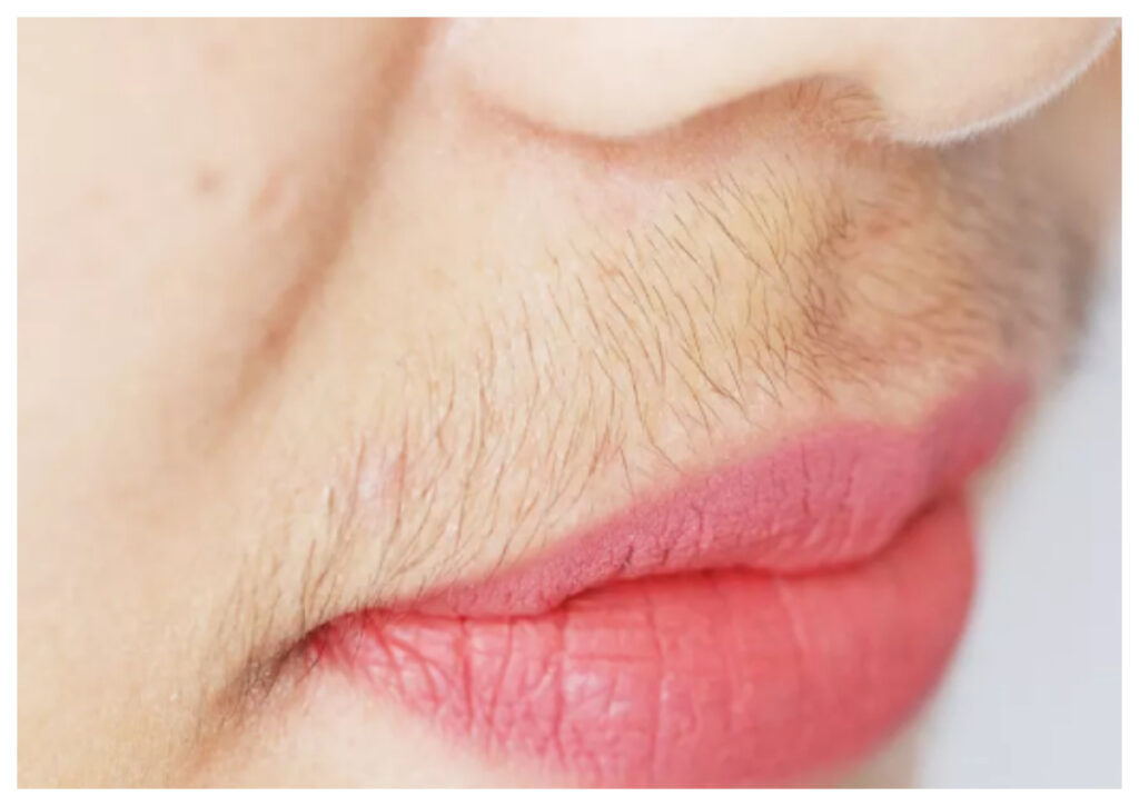 Cara Efektif Menghilangkan Kumis pada Wanita