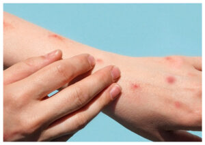 Cegah Cacar Monyet, Kemenkes Perketat Skrining WNA