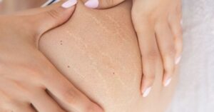 Menguak Penyebab Stretch Mark di Paha dan Cara Mengatasinya