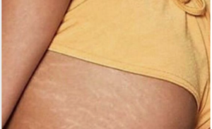 Stretch Mark di Bokong: Penyebab, Pencegahan, dan Cara Mengatasinya