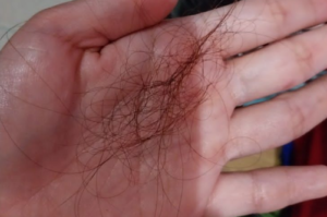 Rambut Rontok? Atasi dengan Makanan Bergizi Ini!