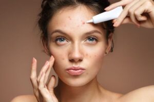 Cara Menghilangkan Jerawat Akibat Skincare