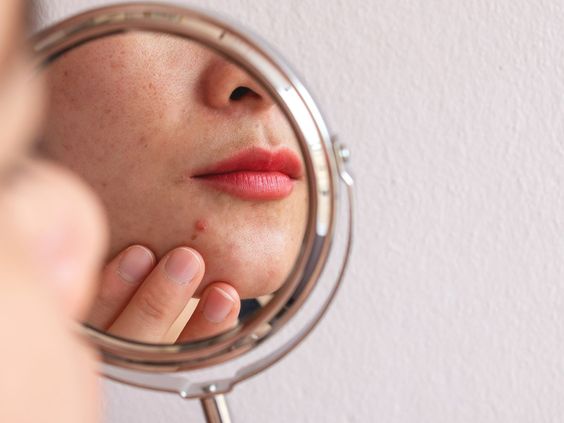 Ciri-Ciri Breakout Karena Skincare