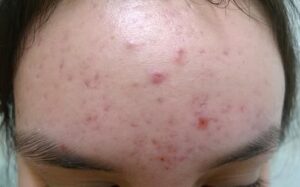 Ciri Ciri Muka Iritasi Karena Skincare