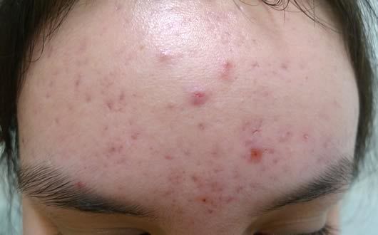 Ciri Ciri Muka Iritasi Karena Skincare