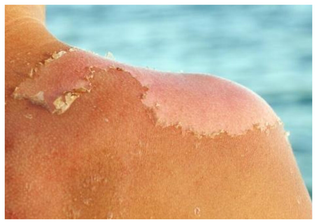 Langkah Mudah Mengobati Kulit Terbakar Akibat Sinar UV