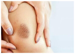 Waspadai Gejala Diabetes pada Kulit