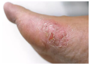 Ulkus Diabetikum: Luka pada Kaki yang Tak Boleh Diabaikan