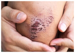 Mengatasi Bekas Koreng dengan Metode Terbaik