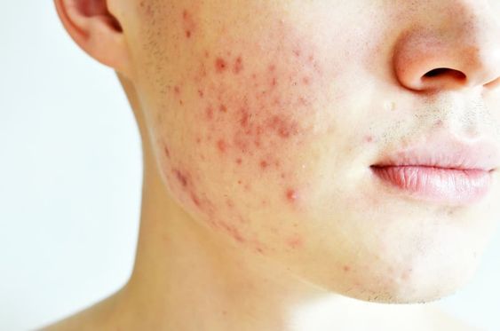 Skincare Terbaik untuk Menghilangkan Bekas Jerawat