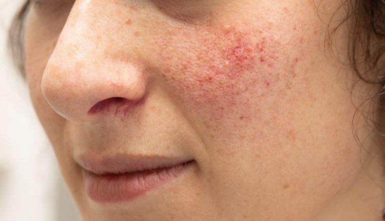 Wajah Gatal Setelah Pakai Skincare Baru