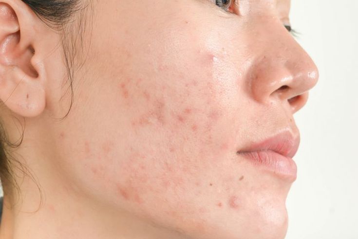 Kenapa Pakai Skincare Malah Jerawatan