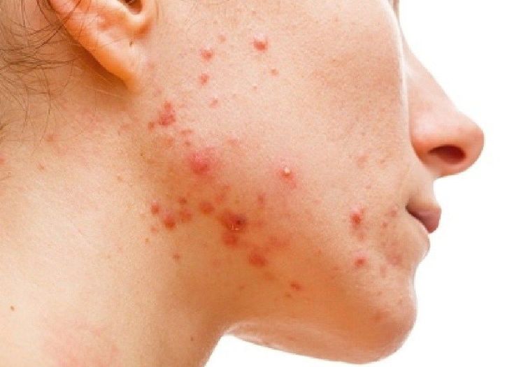 Ciri Jerawat Karena Tidak Cocok Skincare