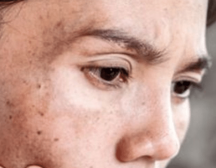 Skincare untuk Warna Kulit Tidak Merata