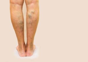 Say Goodbye to Varises, Solusi Modern untuk Kesehatan Kaki Anda