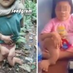 Begini Kondisi Anak Perempuan 10 Tahun di Nias Selatan Alami Cacat Permanen Usai Dianiaya Keluarga, Kaki Bengkok Tak Berbentuk
