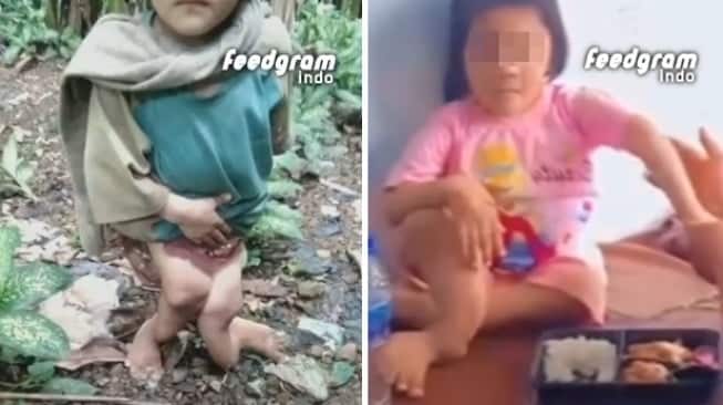 Begini Kondisi Anak Perempuan 10 Tahun di Nias Selatan Alami Cacat Permanen Usai Dianiaya Keluarga, Kaki Bengkok Tak Berbentuk