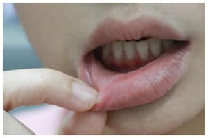 Ini 7 Bahan Alami untuk Mengatasi Sariawan