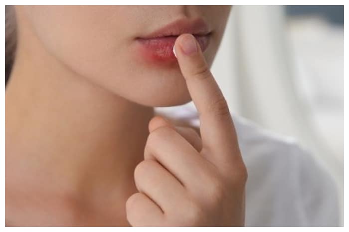 Panduan Mengatasi Herpes di Bibir dan Mulut Secara Tepat