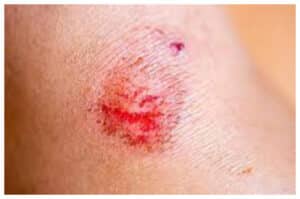 Luka di Kulit? Ini Cara Menanganinya dengan Benar