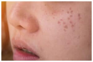 Bintik Hitam di Wajah: Penyebab dan Cara Mengatasinya