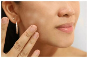 Mengenal Penyebab dan Cara Atasi Putih-Putih di Wajah