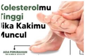 Kenali Ciri-Ciri Kolesterol Naik dan Cara Mencegahnya