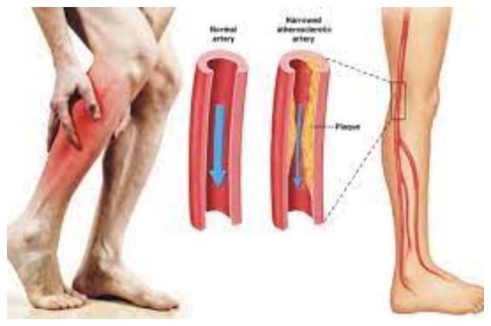 Kram Betis Mengganggu? Kenali Penyebab dan Cara Mengatasinya