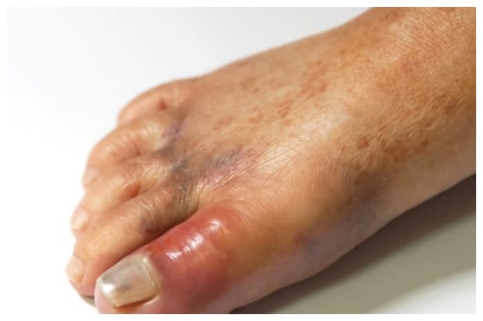 Penyebab Jari Kaki Bengkak dan Langkah Awal Penanganannya