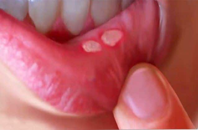 Makanan Penyebab Sariawan