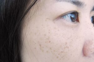 Rekomendasi Skincare Menghilangkan Bintik Hitam di Wajah