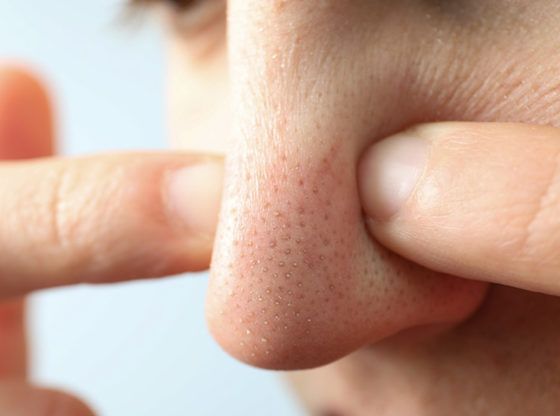 Skincare untuk Menghilangkan Blackhead