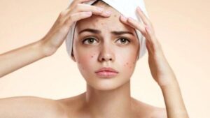 Kulit Berjerawat? Ini Rangkaian Basic Skincare Untuk Kulit Berjerawat