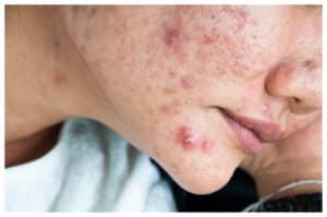 Strategi Efektif Atasi dan Cegah Jerawat Batu