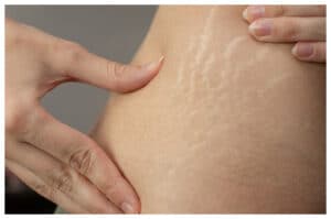 Stretch Mark Mengganggu? Ini Solusi Alami dan Medis yang Bisa Dicoba