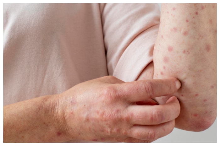 Ini 5 Ciri-Ciri Cacar Air dan Pentingnya Deteksi Dini