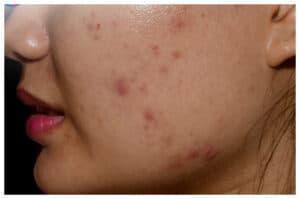 Tips Menyamarkan Noda Hitam Bekas Jerawat dalam Semalam