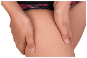Stretch Mark: Penyebab, Risiko dan Cara Menghilangkannya