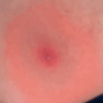 Lyme Disease: