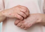 8 Makanan yang Tidak Boleh Dimakan Saat Cacar Air agar Cepat Sembuh