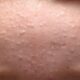 Skincare yang Cocok untuk Kulit Bruntusan