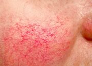 Urat di Wajah Terlihat Setelah Pakai Skincare: Apakah Berbahaya? Ini Penjelasan Lengkapnya